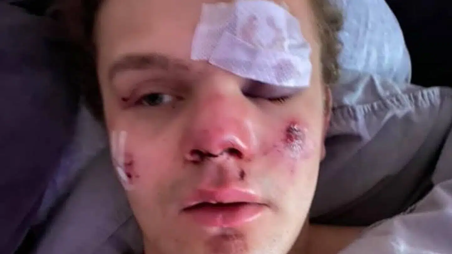 Lauritz Lindbow Wind vågnede på hospitalet med en brækket næse, flækket øjenbryn og en gedigen hjernerystelse.