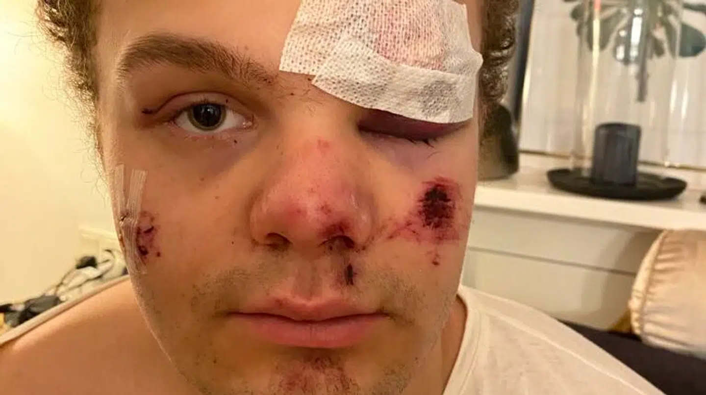 Sådan så Lauritz Lindboe Wind ud i tiden efter overfaldet i 2020.