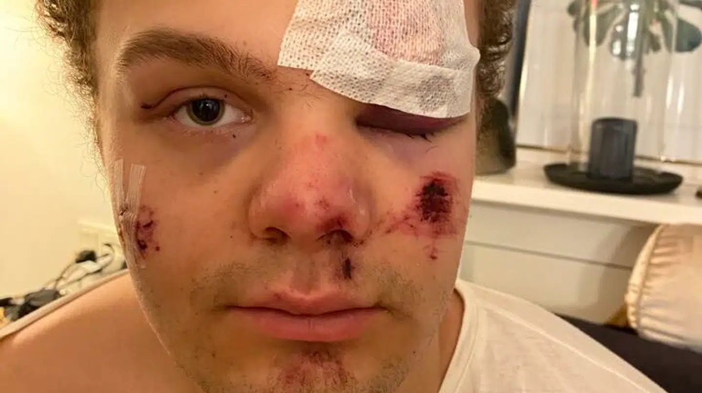 Overfaldet kostede Lauritz Lindboe Wind en brækket næse, et flækket øjenbryn og en gedigen hjernerystelse.