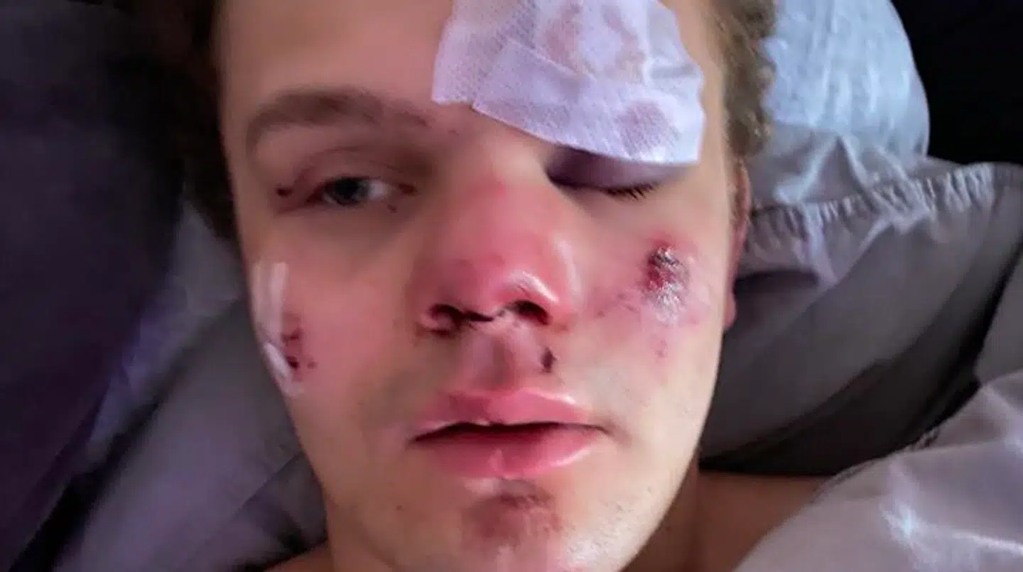 Lauritz Lindboe Wind fik både næsen brækket, øjenbrynet flækket og en gedigen hjernerystelse efter overfaldet.