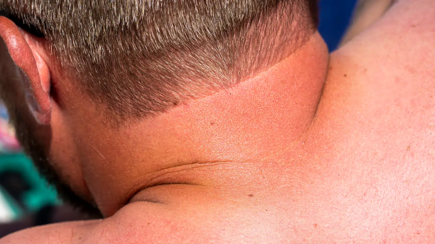 Flere bliver ramt af hudkræft, men der er stor forskel på, hvor mænd og kvinder rammes.