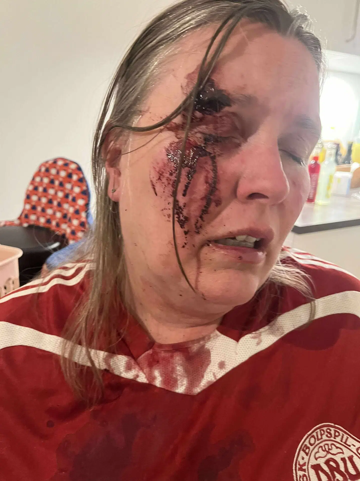 Sådan så kvinden, der blev overfaldet på banegården, efterfølgende ud. Hun har givet B.T. lov til at bringe billedet.