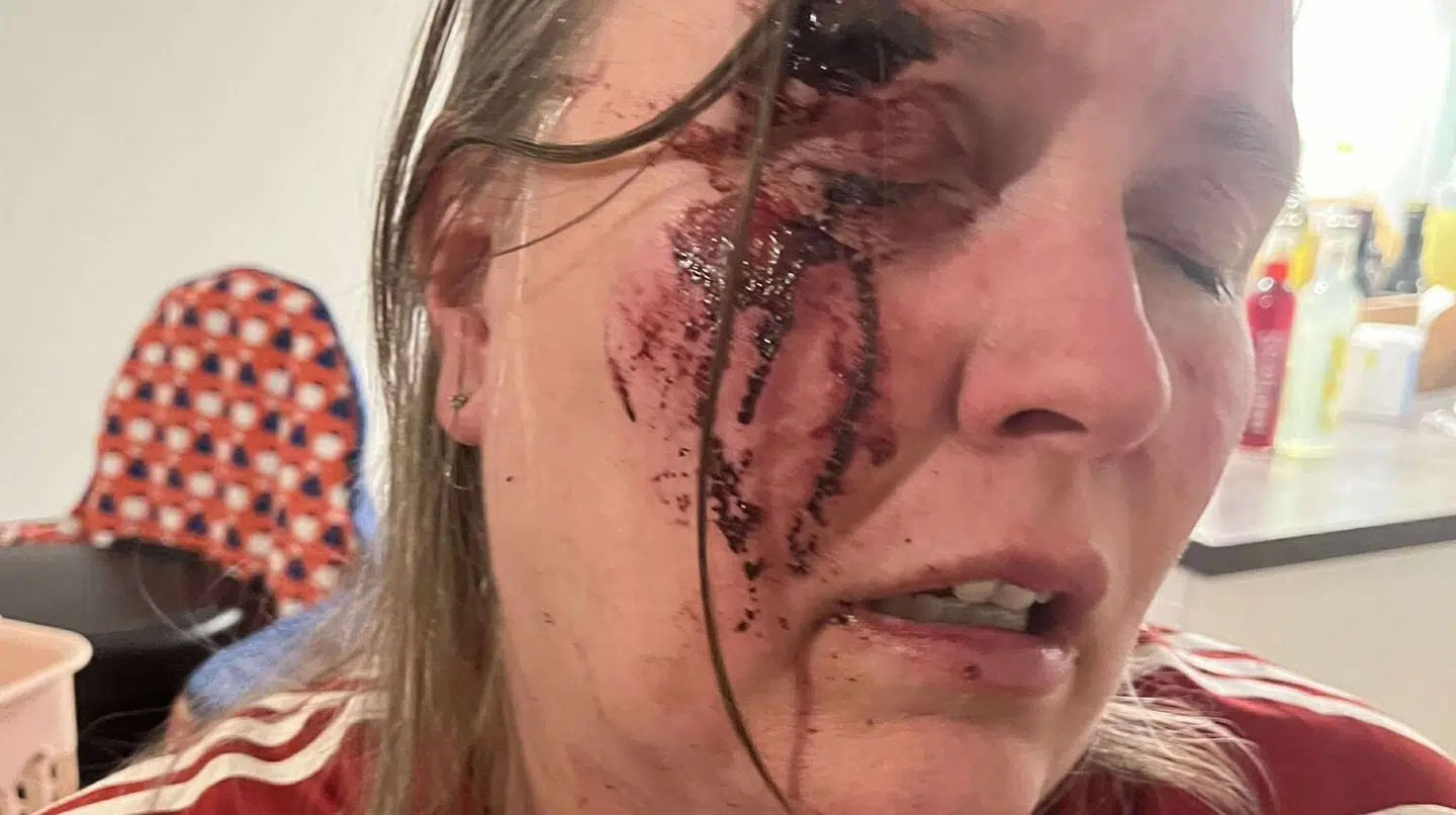 Sådan så kvinden, der blev overfaldet på banegården, efterfølgende ud. Hun har givet B.T. lov til at bringe billedet.