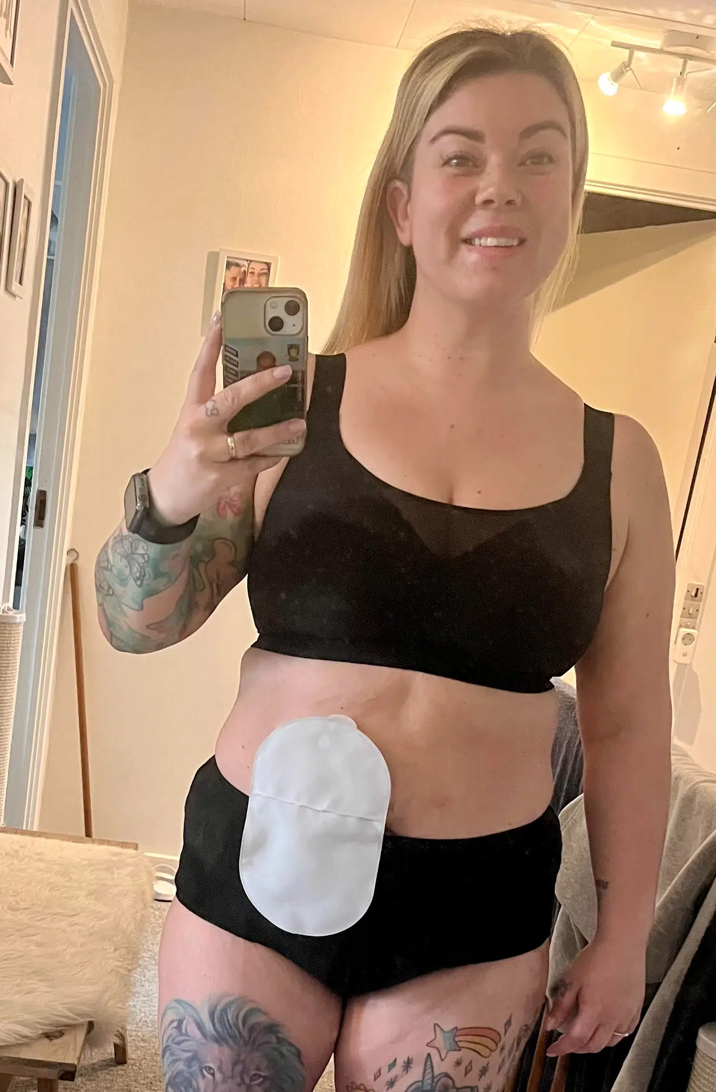 Siden operationen for et år siden har Amanda Julie Fridh Riis tabt sig en del. Hun har fundet glæden ved at træne, fordi hun ikke længere lever med smerter.