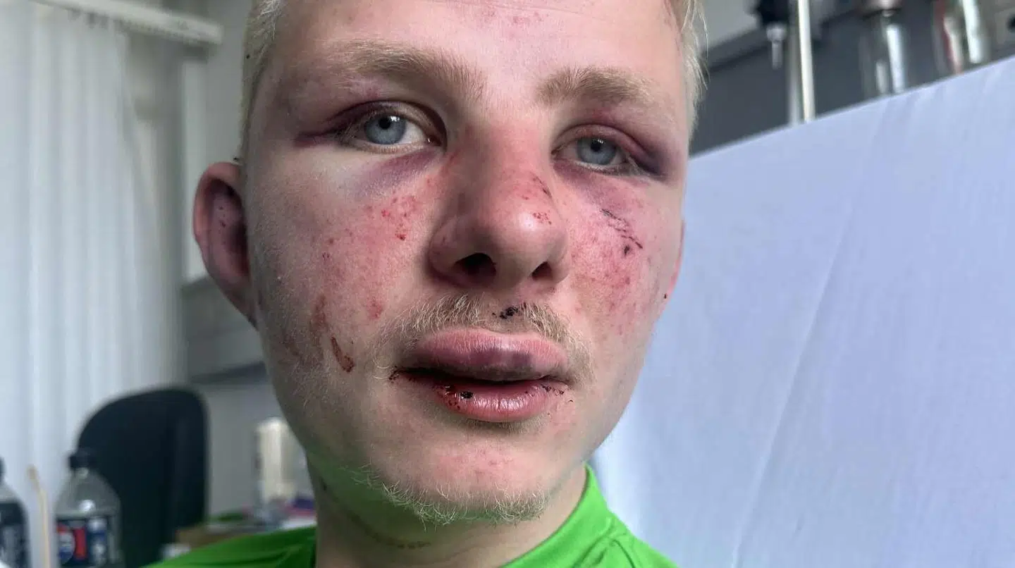 Her ses Frederik Andersen efter overfaldet