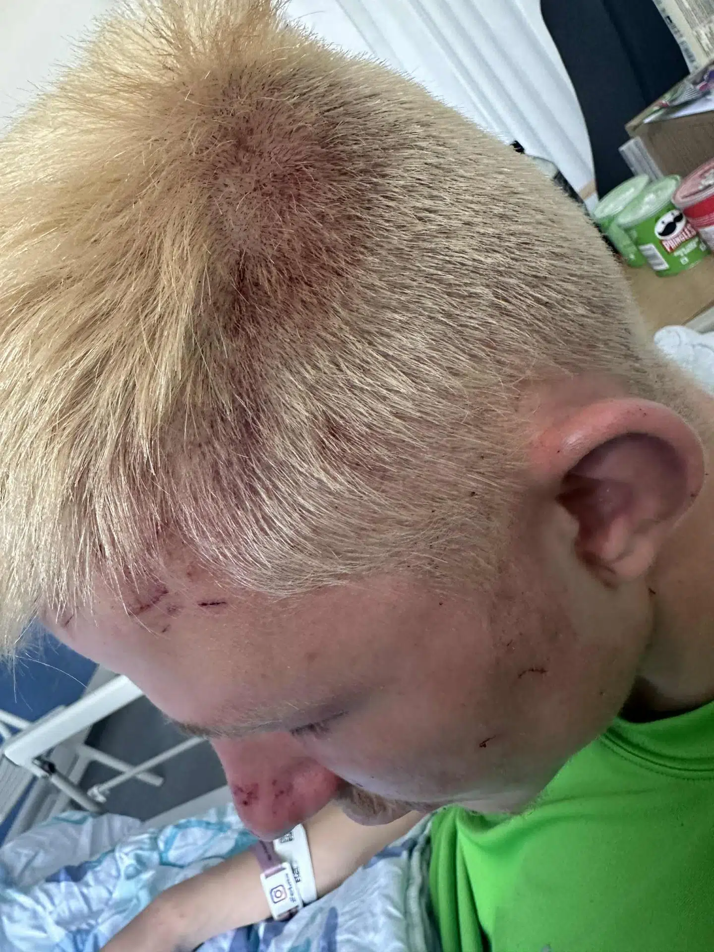 Her ses Frederik Andersen efter overfaldet