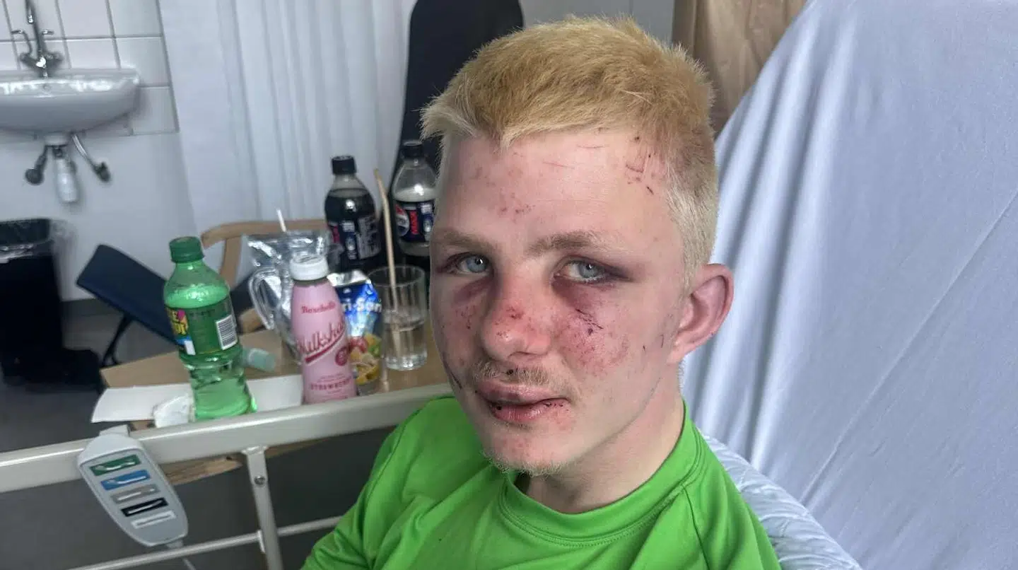 Her ses Frederik Andersen efter overfaldet