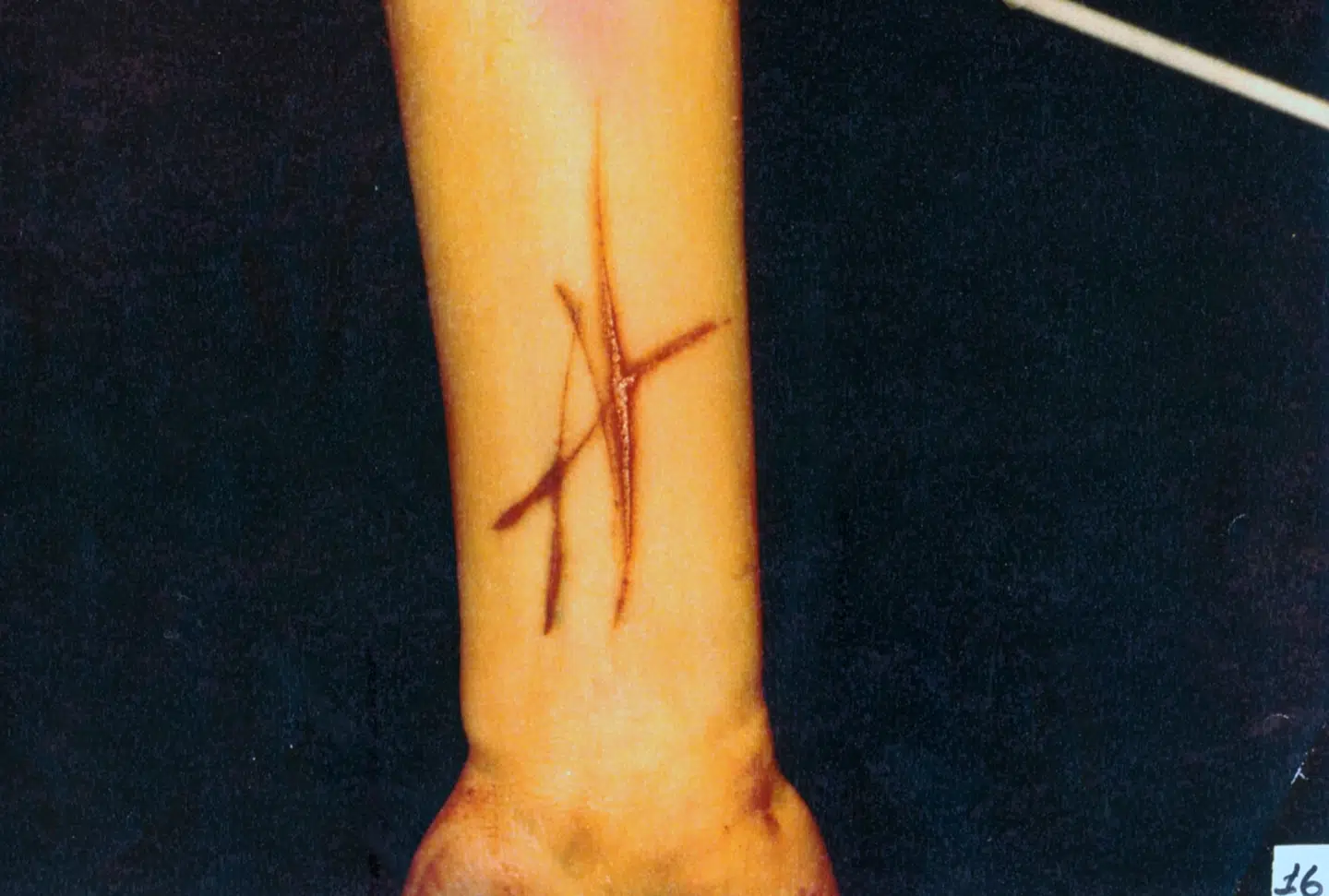 Her nærbillede af Stine Geislers højre underarms indside med bogstavlignende overfladiske snitsår.