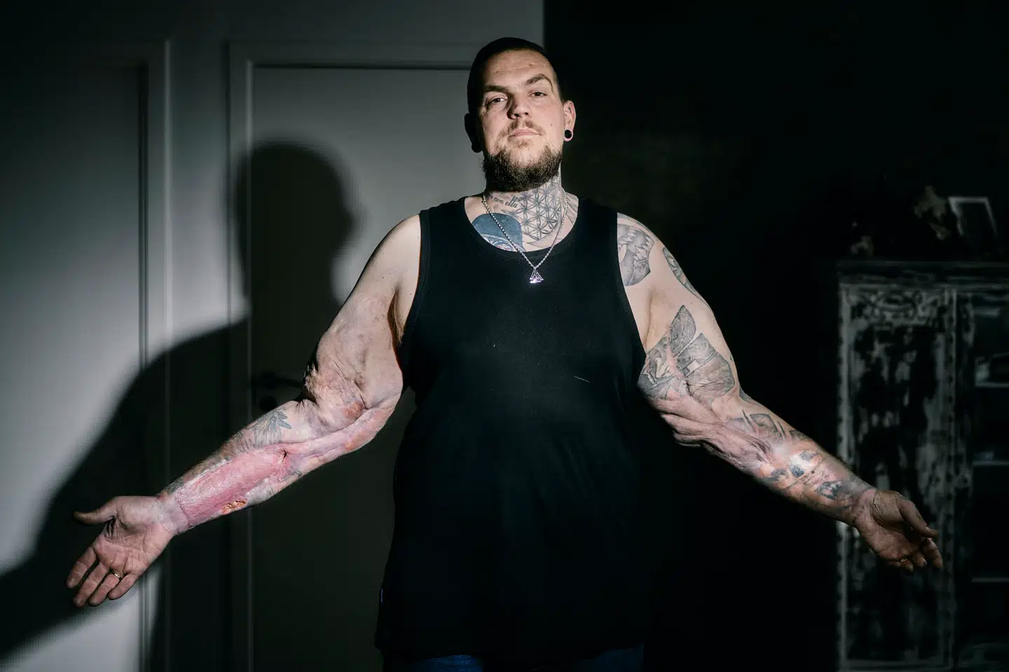 Kenneth Beer Hansen sprøjtede som 19-årig parrafinolie i sine arme for at få store overarme. Det har givet ham alvorlige helbredsskader, og det er han langtfra den eneste, der har fået efter den form for dopingmisbrug, viser nye oplysninger fra Herlev Hospital.