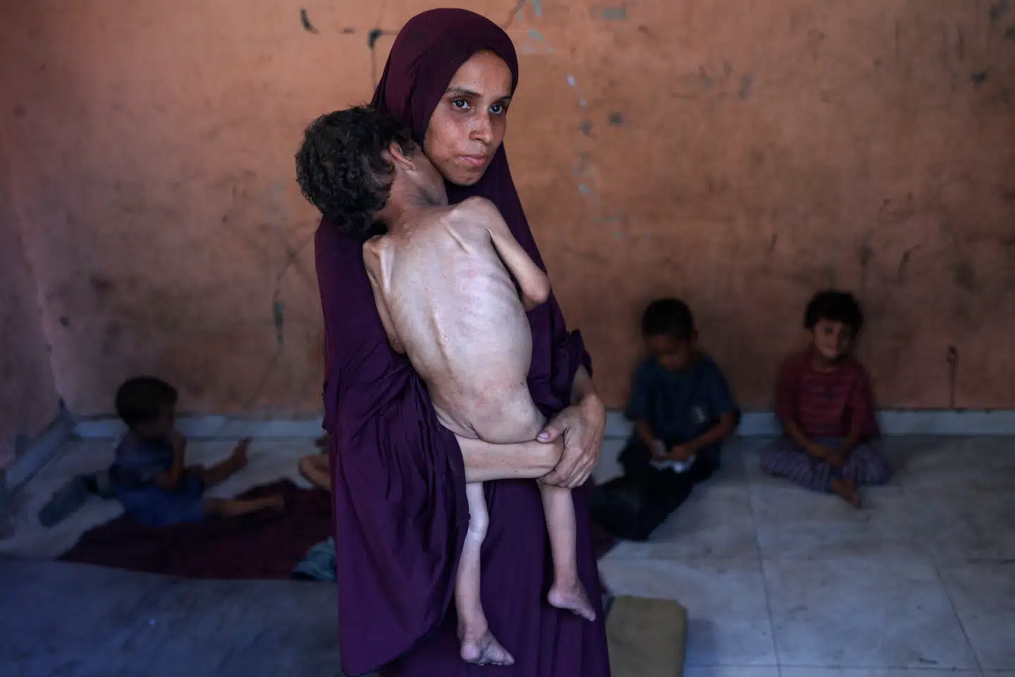 Toårige Yazan Abu Foul i Gaza lider af alvorlig underernæring på grund af akut mangel på mad.