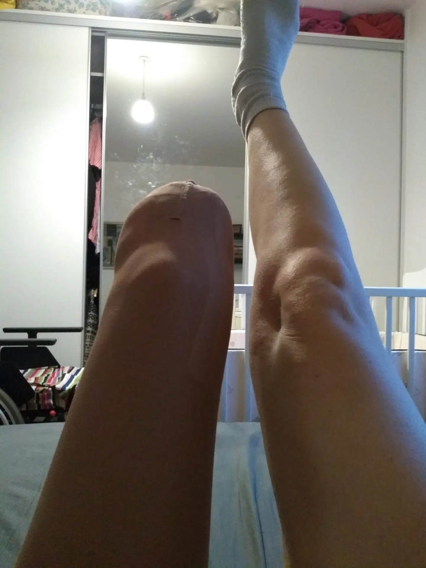 Benet efter den første amputation, hvor knæet stadig er i behold.