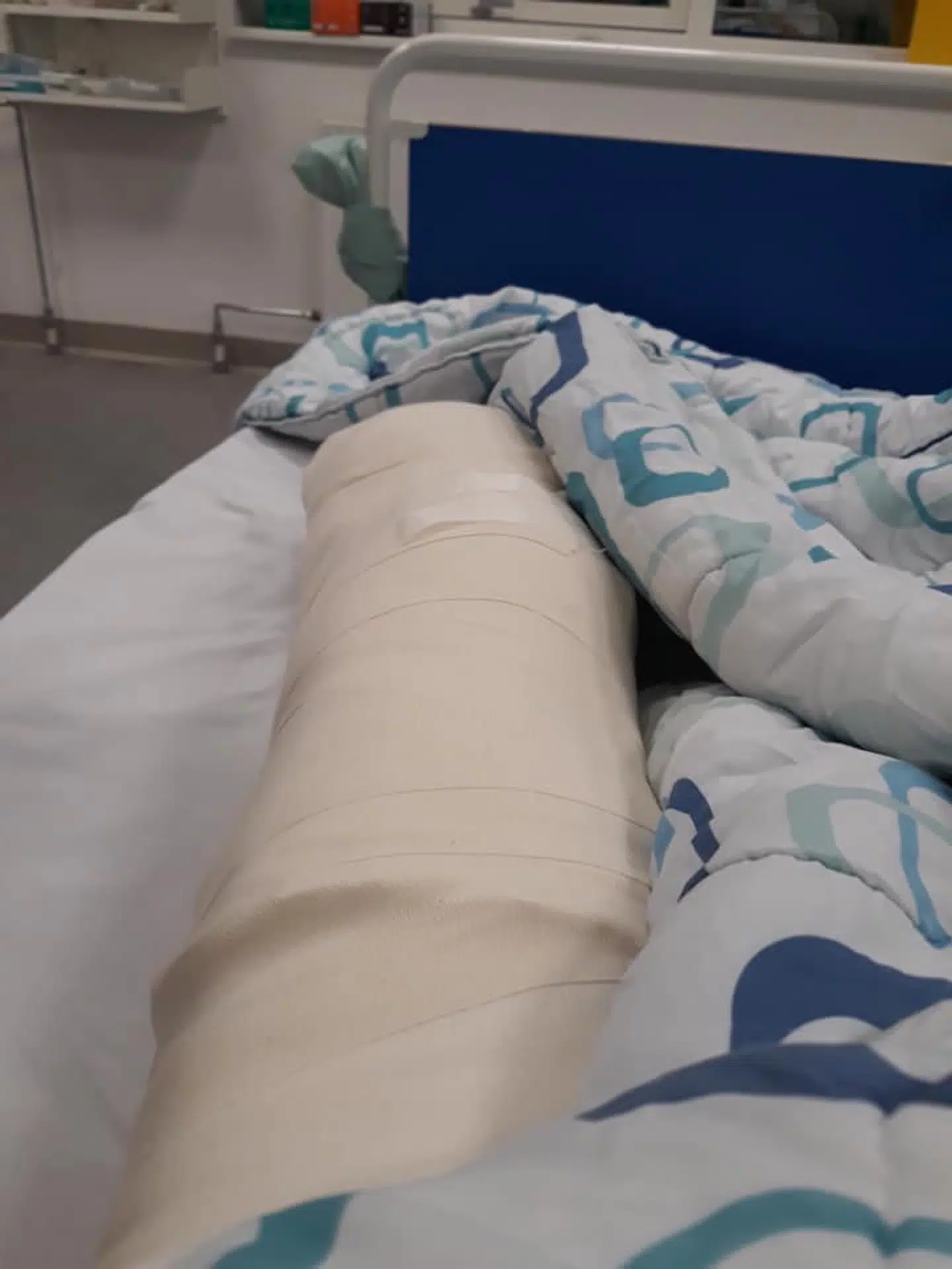 Resten af benet efter operationen.