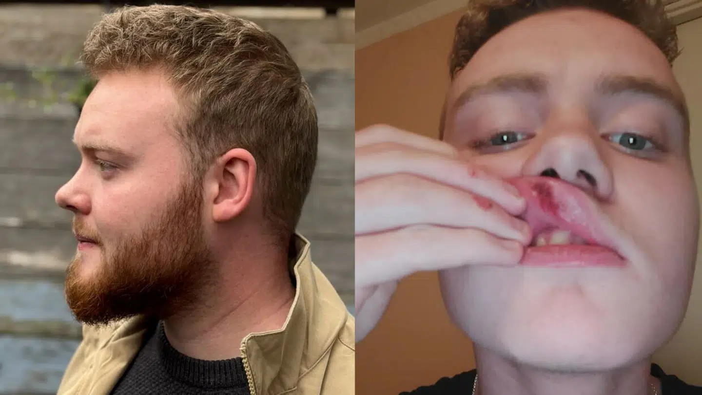 Marcus Alexander Aroli blev overfaldet af syv drenge tilbage i 2020.