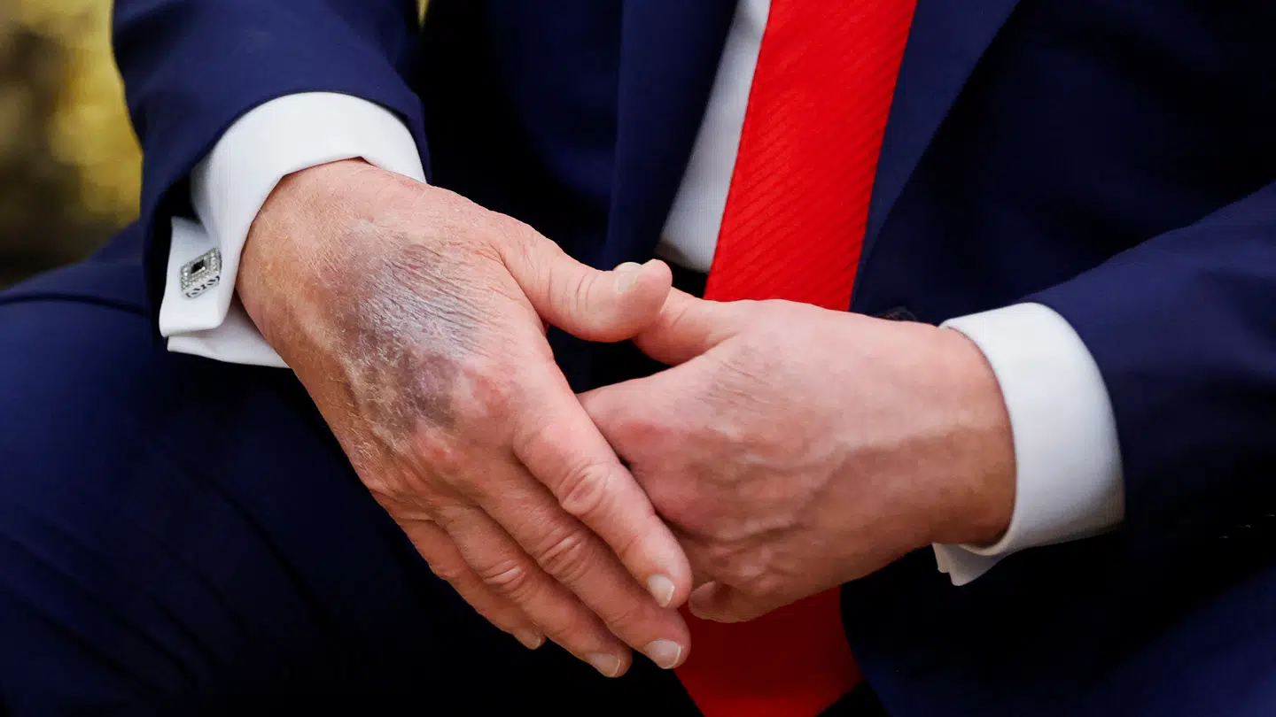 Donald Trumps højre hånd havde en tydelig plamage ved dagens pressemøde med den sydkoreanske præsident.