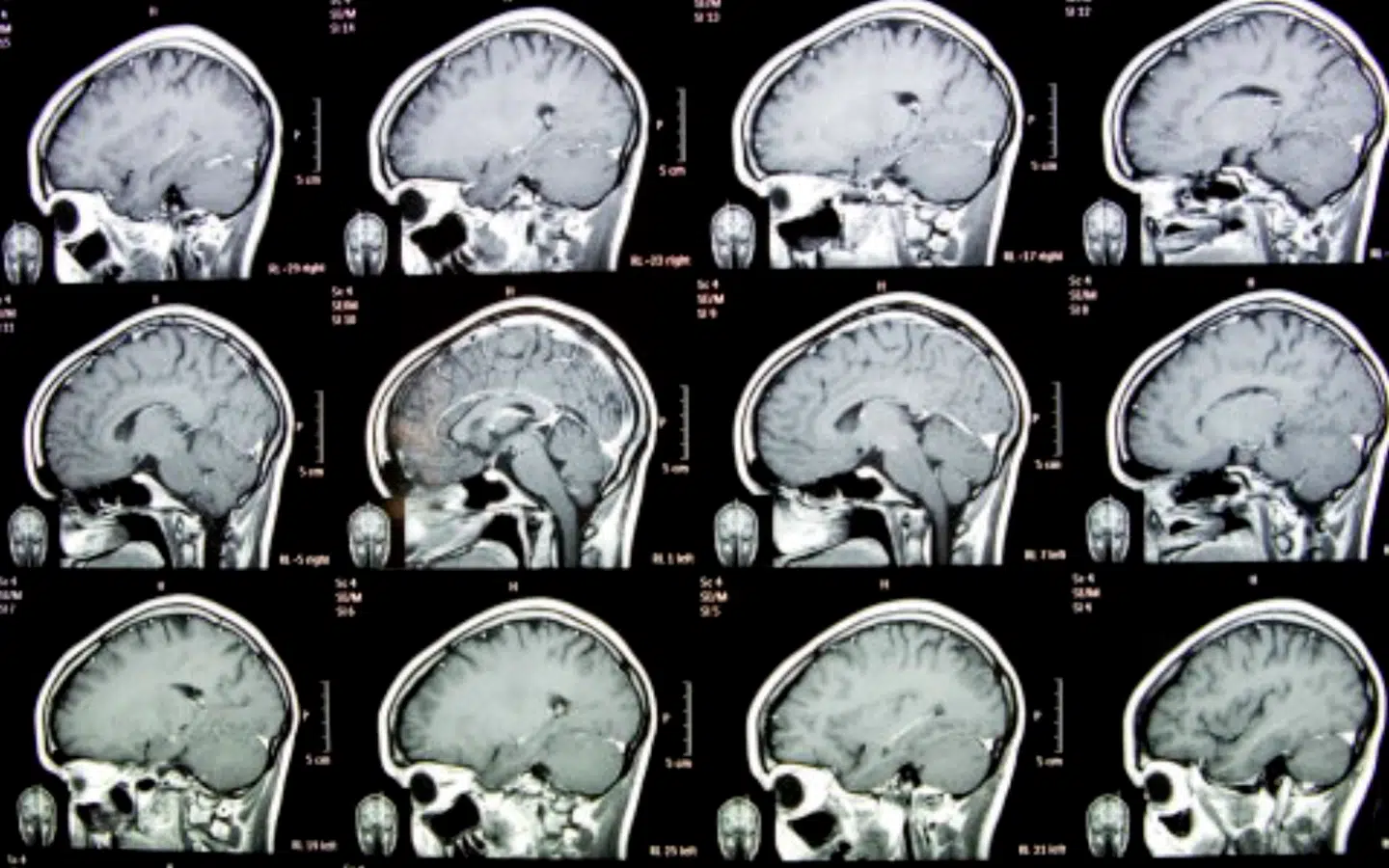 Forskere fra University of Cambridge har for første gang sammenlignet hjerneaktiviteten hos tre mennesker før og efter amputation af en arm. Foto: Erik Refner
