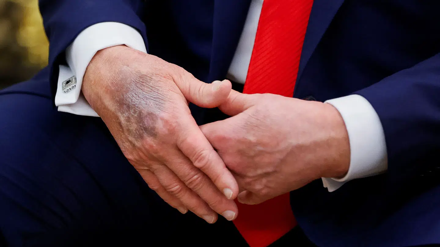 Det blå mærke på Donald Trumps hånd har vakt opsigt. Ifølge Trump er det kommet, da rigtig mange ønsker at trykke hans hånd.