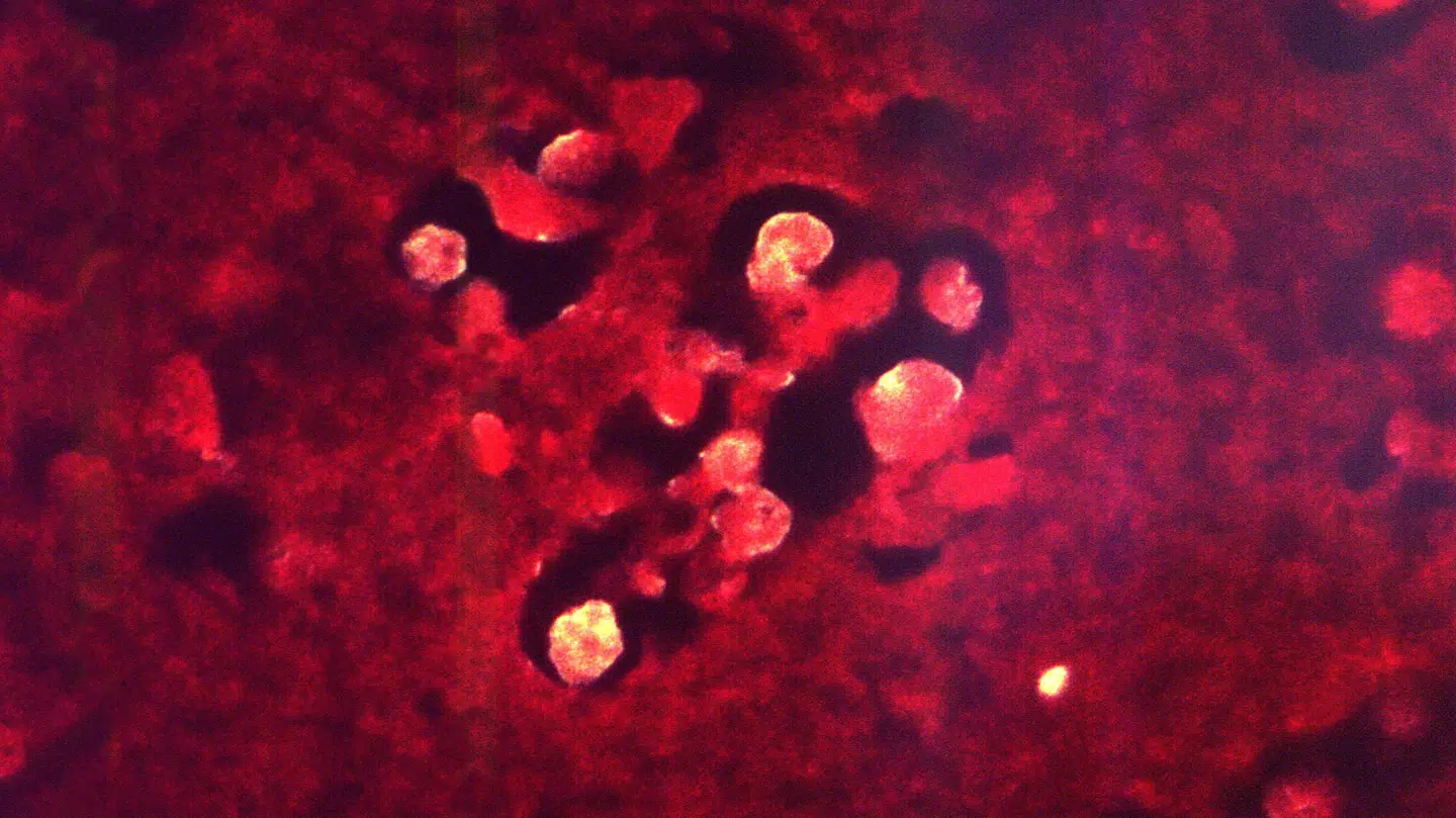 En helt ekstremt sjælden sygdom spreder sig i øjeblikket i Indien.