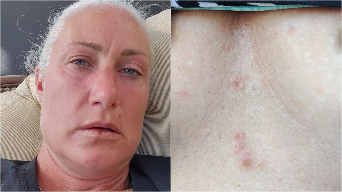 Luna Vikke får udslæt i ansigtet og på brystet efter ganske kort tid i skimmelejligheden.