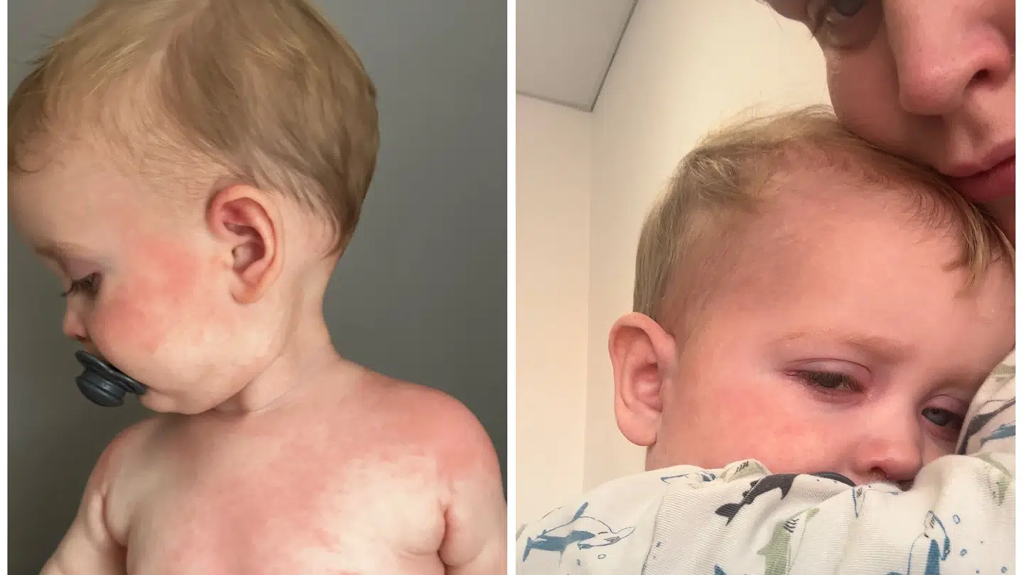 Efter Louis startede på pencillinen fik han udslæt og røde blodsprængte øjne.