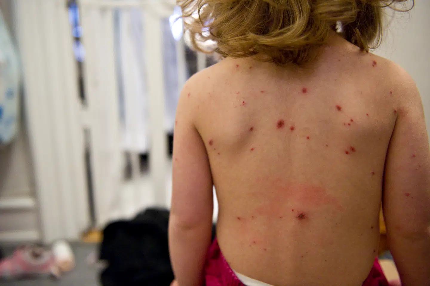 På otte år har der været over 20.000 opkald vedrørende milde til moderate tilfælde af skoldkopper til 1813-akuttelefonen i hovedstaden. Det får nu flere partier til at reagere.