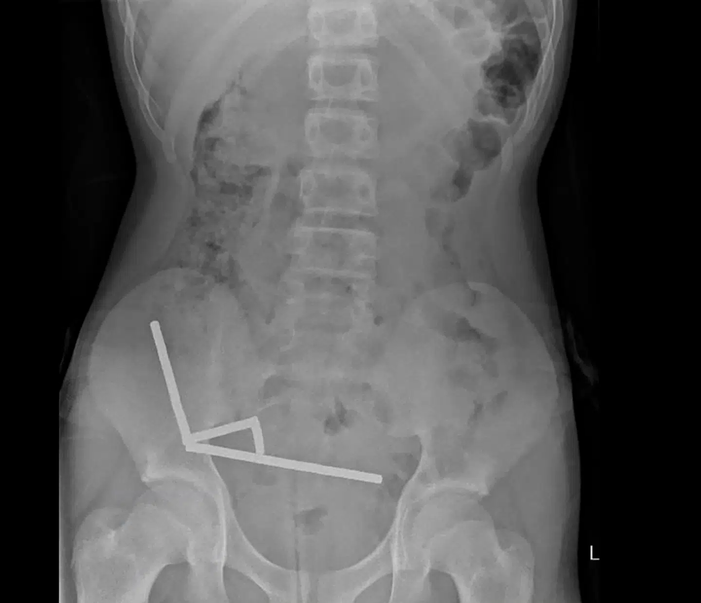 Kirurger på Tauranga Hospital i New Zealand måtte fjerne en del af drengens tarm, efter han havde spist op til 100 af de små magneter, oplyser New Zealand Medical Journal.