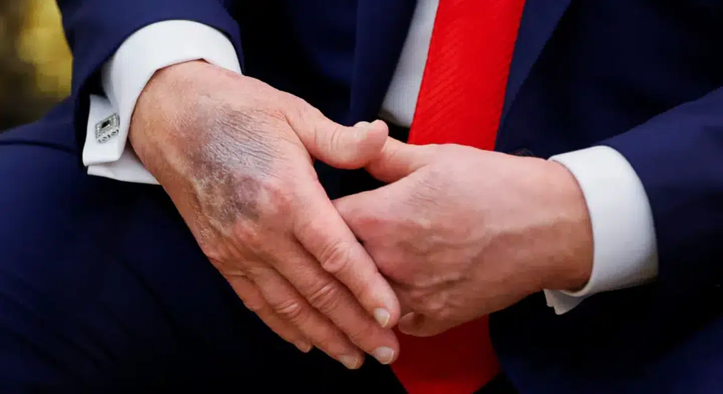 Det blå mærke på Donald Trumps hånd har vakt opsigt. Ifølge Trump er det kommet, da rigtig mange ønsker at trykke hans hånd.