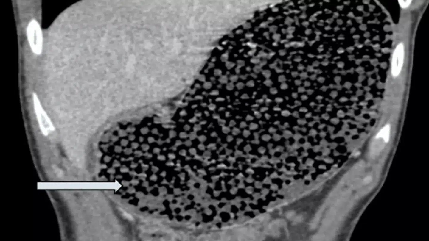 En CT-scanning viser de mange små, runde vandperler spredt gennem den 19-årige drengs mave og tarm.