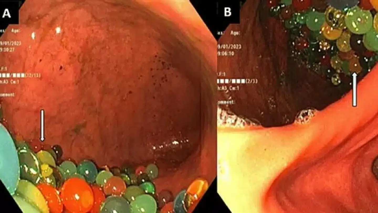 Her viser gastroskopibilleder de mange farverige vandperler i maven og den øverste del af tarmen.