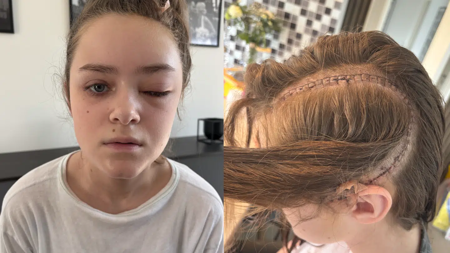 Her ses Ida efter ulykken.