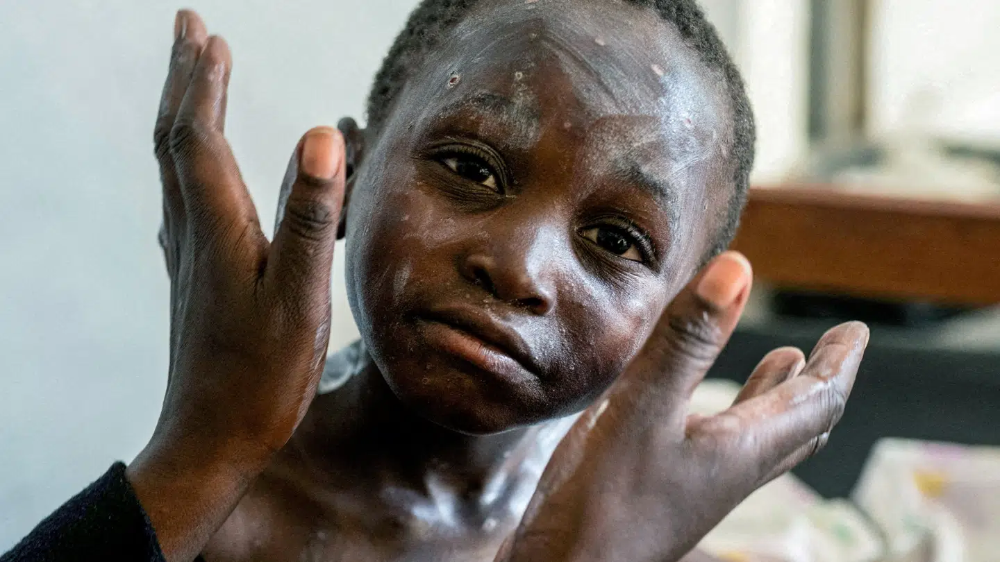 Længe mpox især været registreret i Central- og Østafrika.