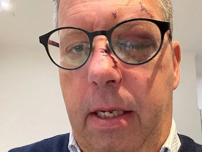 Borgmesterkandidat brækker næsen i voldsomt fald