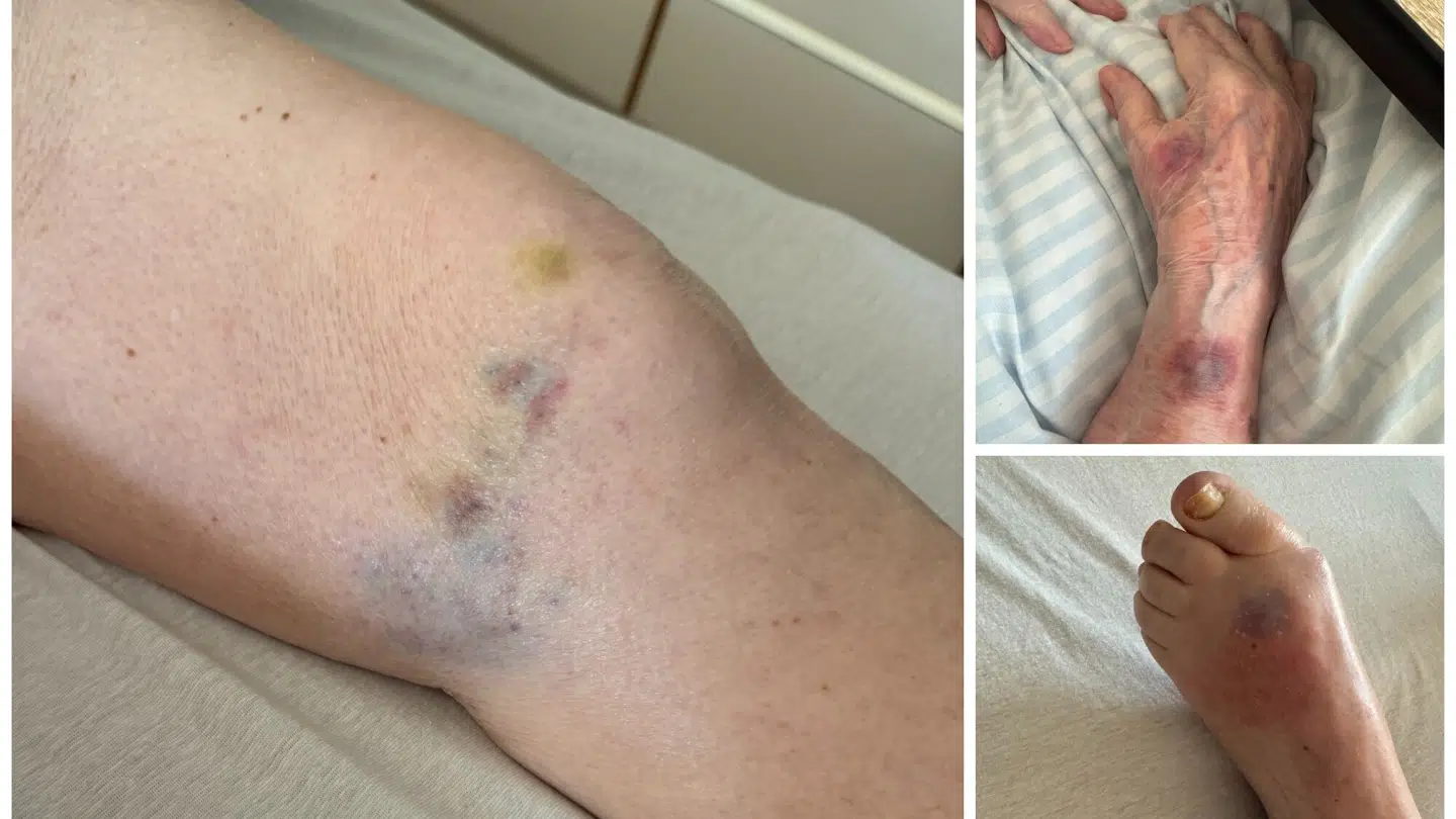 Under flere af sine besøg har Stine Hagen opdaget mærker og sår på Bente Hagen, som personalet ikke har orienteret hende om.