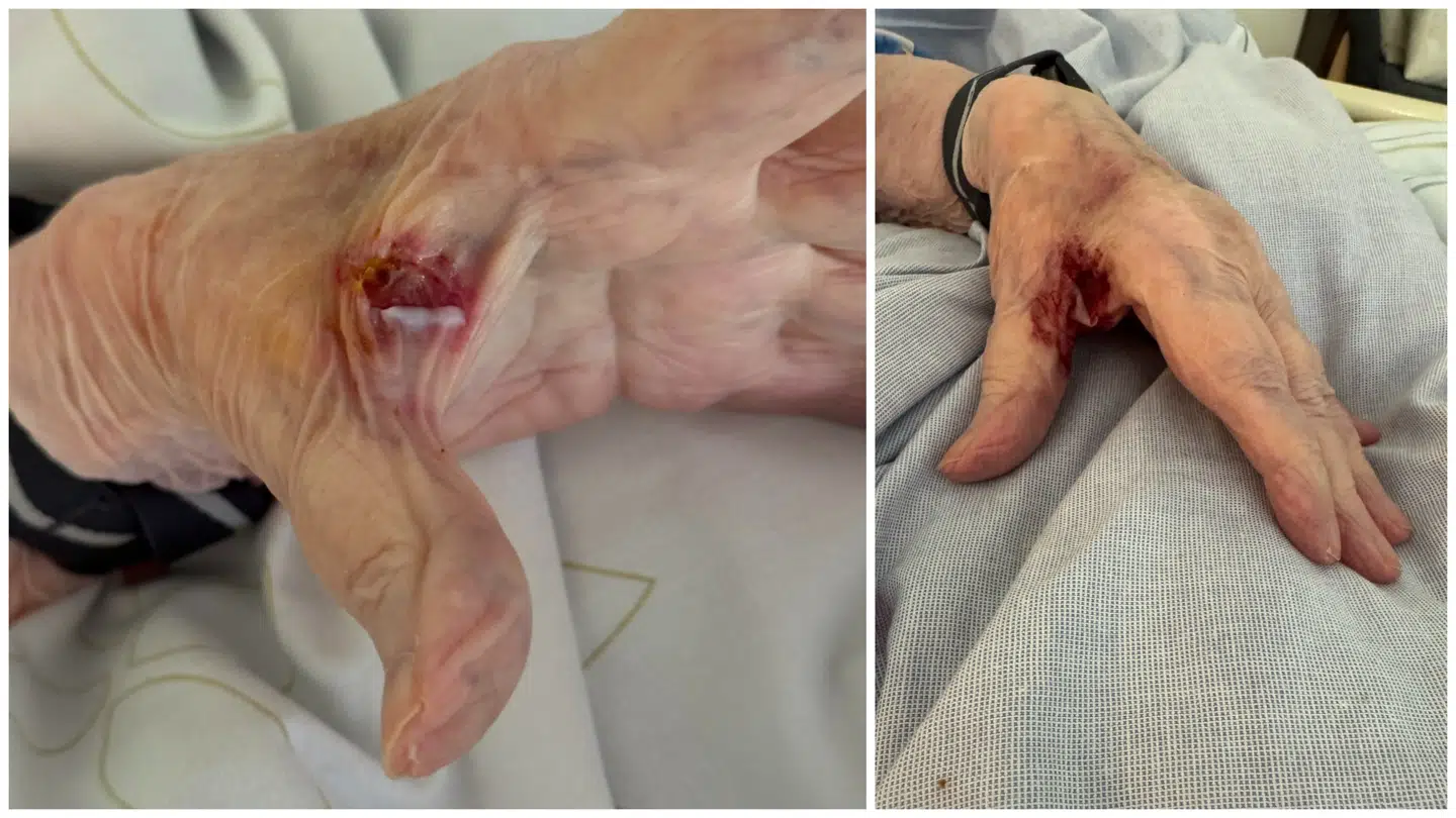 Den 13. maj opdagede Bente Hagen et sår på hendes mor, som personalet hverken havde set eller informeret om.