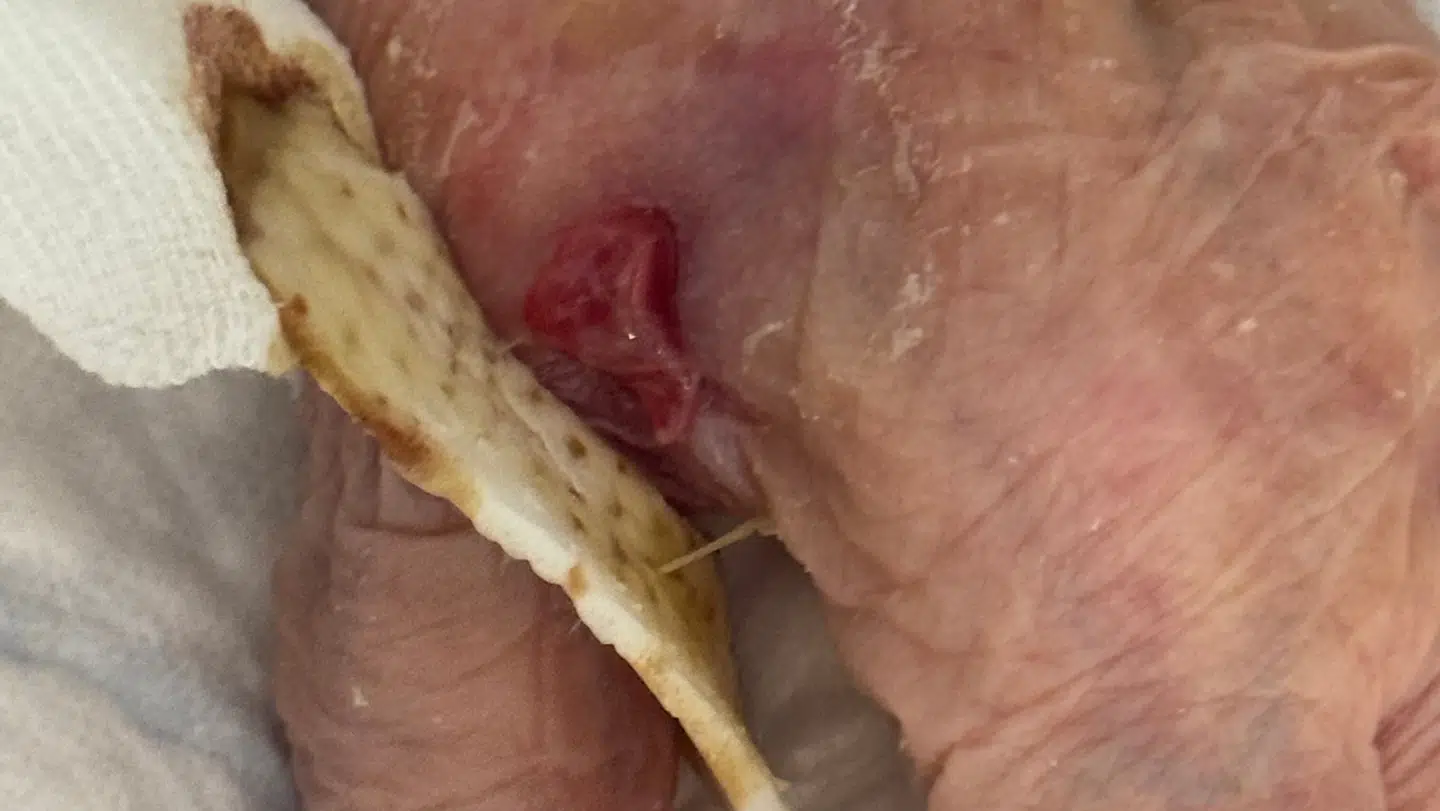 Sådan så Bente Hagens sår ud i juli. Stine Hagen opdagede det selv i maj.