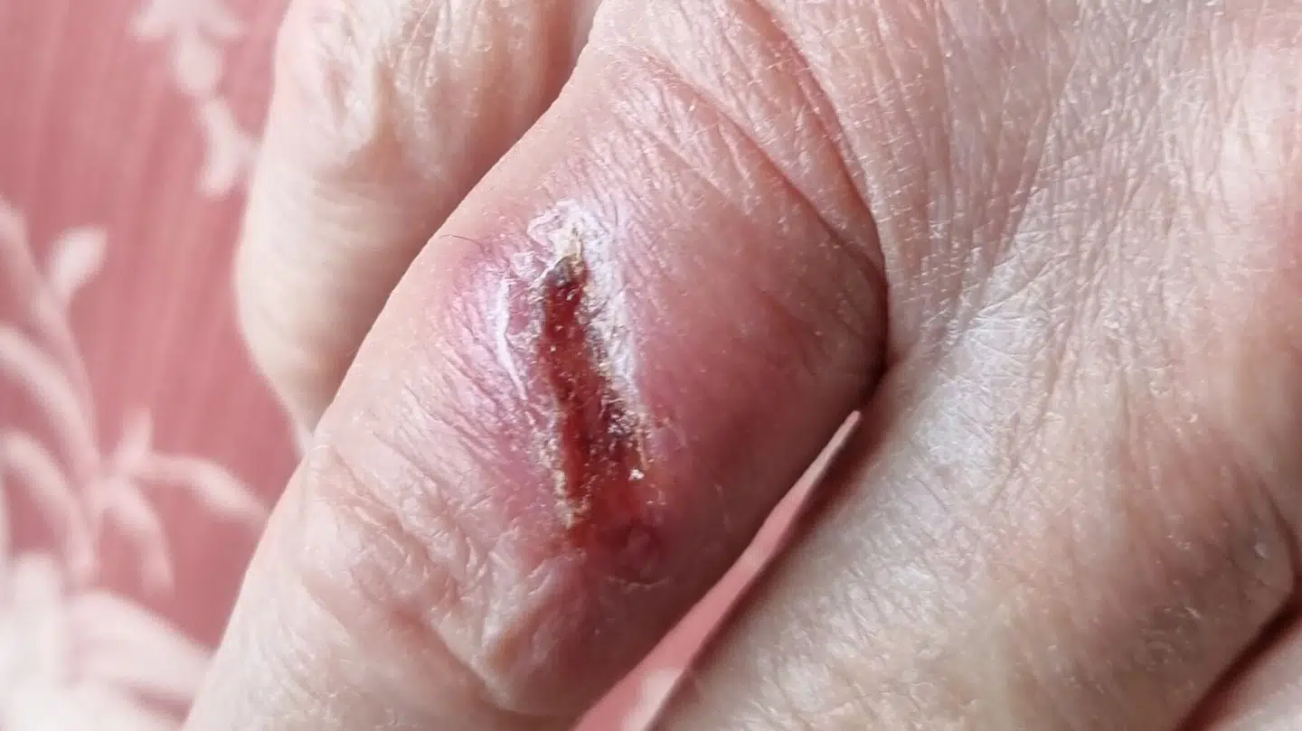 Farens finger måtte behandles med penicillinkur, da der gik betændelse i den.