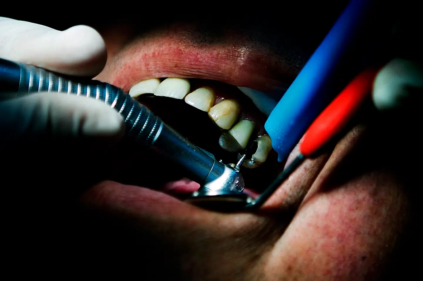 Mange tandlæger udskriver opioider til patienter, der får fjernet visdomstænder. Men håndkøbsmedicin virker lige så godt. Foto: Als Christian, Scanpix