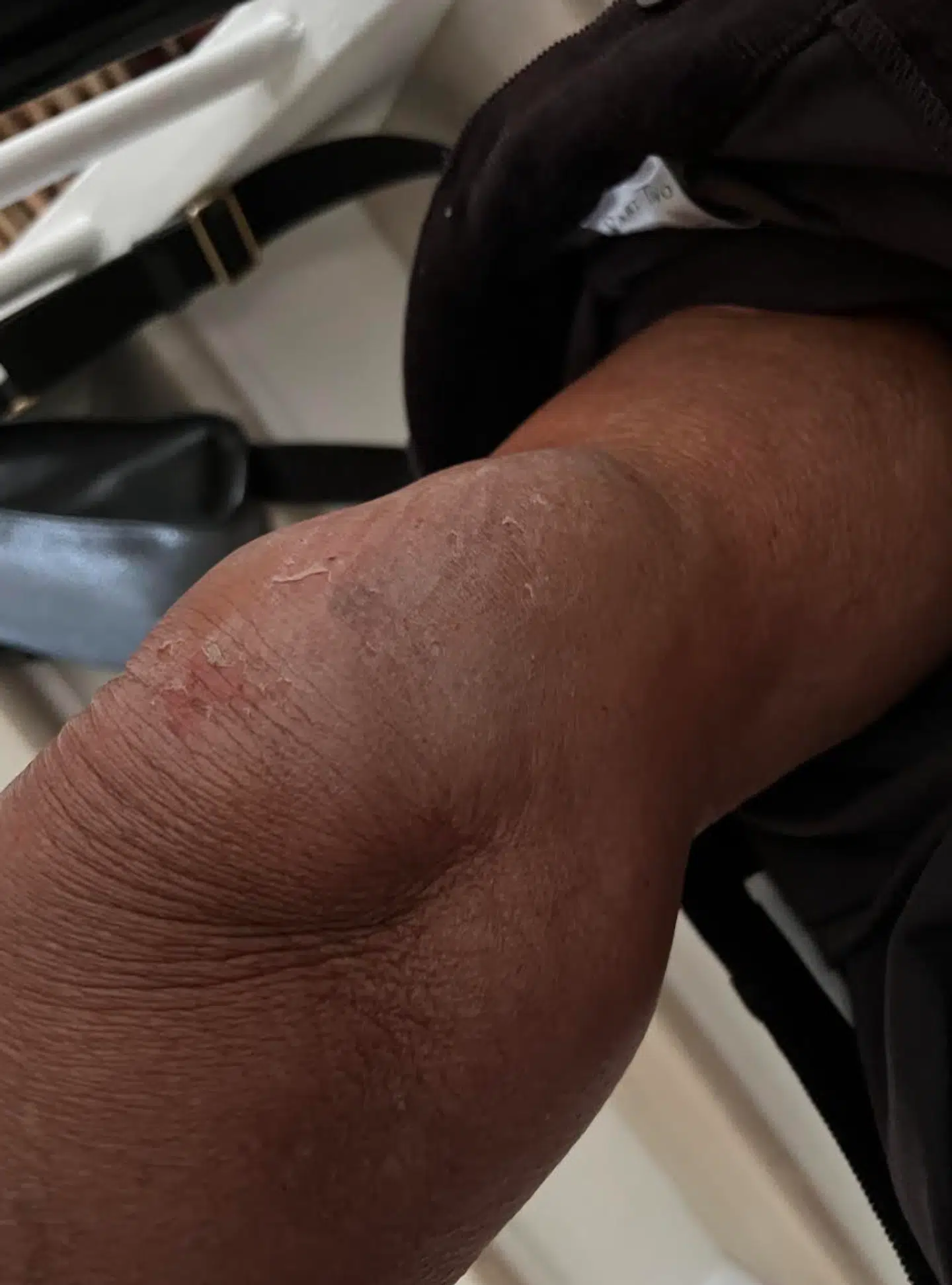 Tina Schjødt fik forstuvet sit knæ kort efter, hun cyklede ud på Femagervej i Hvidovre Kommune mandag morgen. Foto: Privat