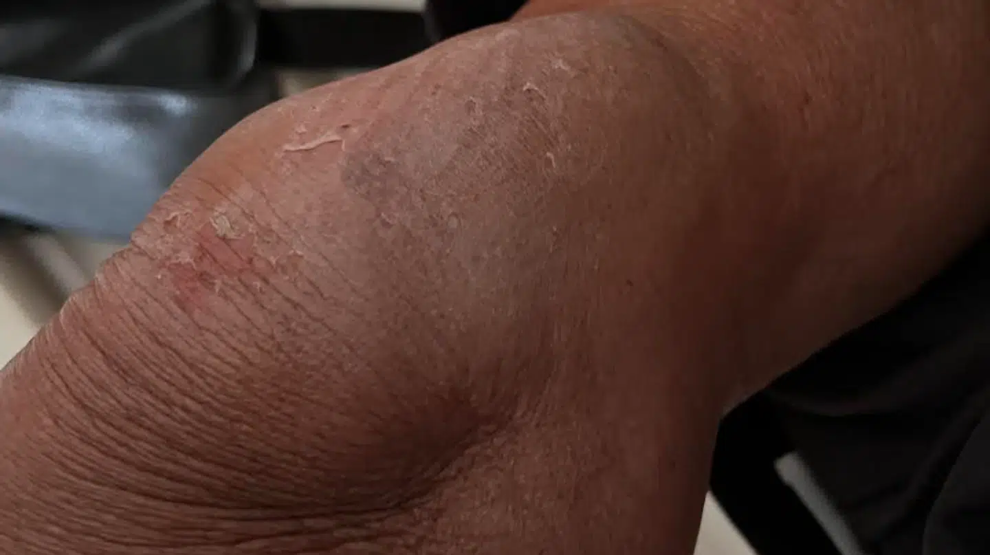 Tina Schjødt fik forstuvet sit knæ kort efter, hun cyklede ud på Femagervej i Hvidovre Kommune mandag morgen. Foto: Privat