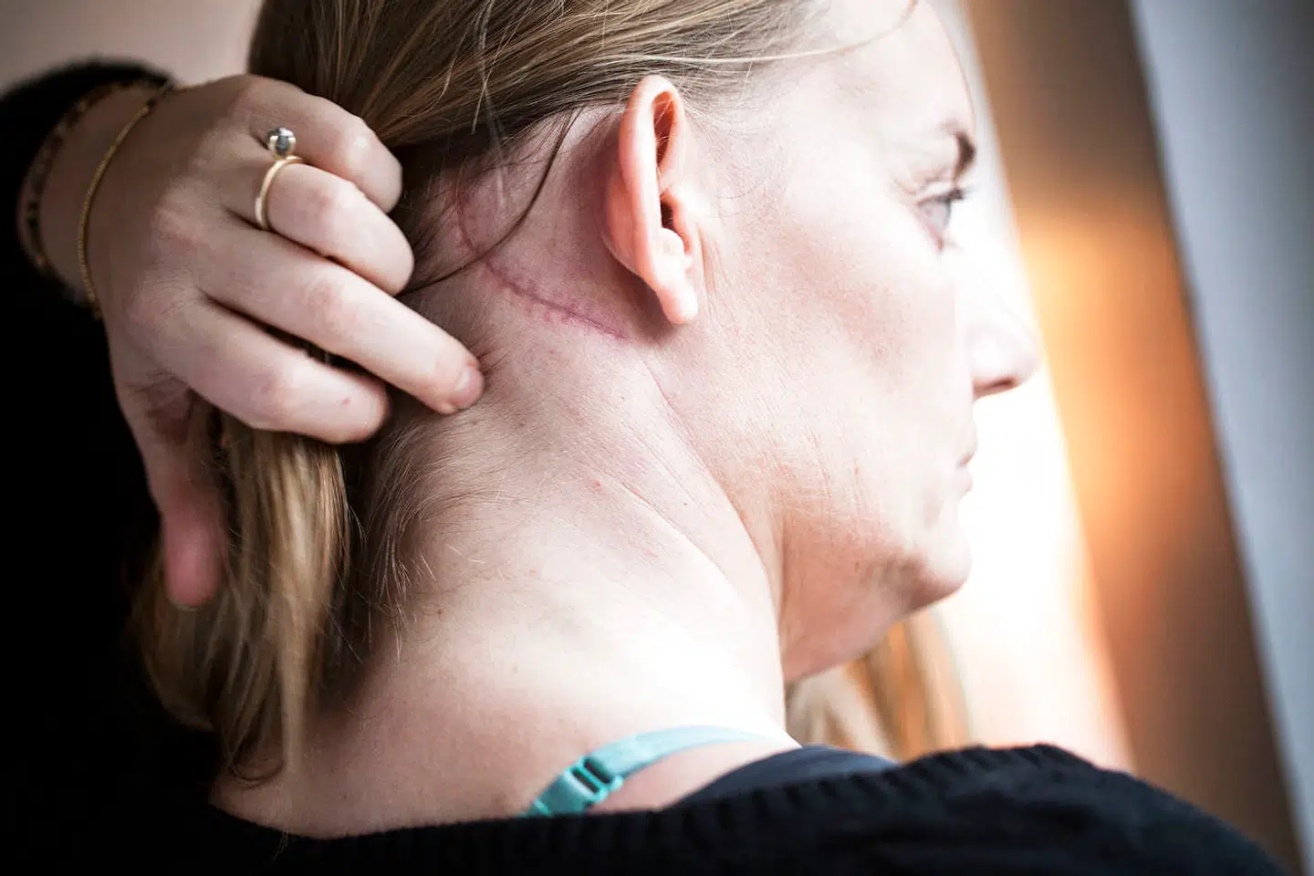 Michelle Hviid viser det ar, der snor sig langs hendes kranium. Et af de få synlige tegn på, hvad hun har været igennem.