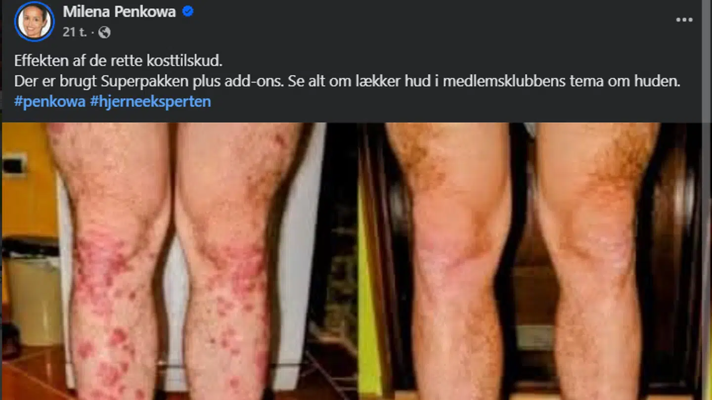 Milena Penkowa falske før og efter billeder