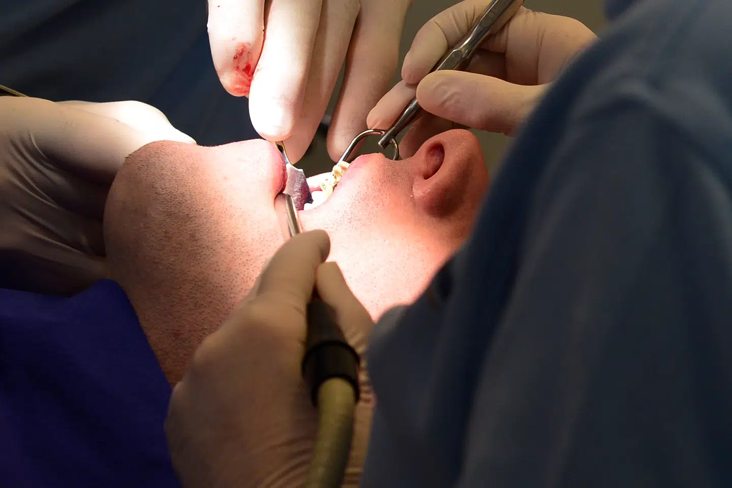 En spørgeskemaundersøgelse blandt danskere med Crohns sygdom eller Colitis Ulcerosa fra 2022, viste at cirka en tredjedel havde svær paradentose.