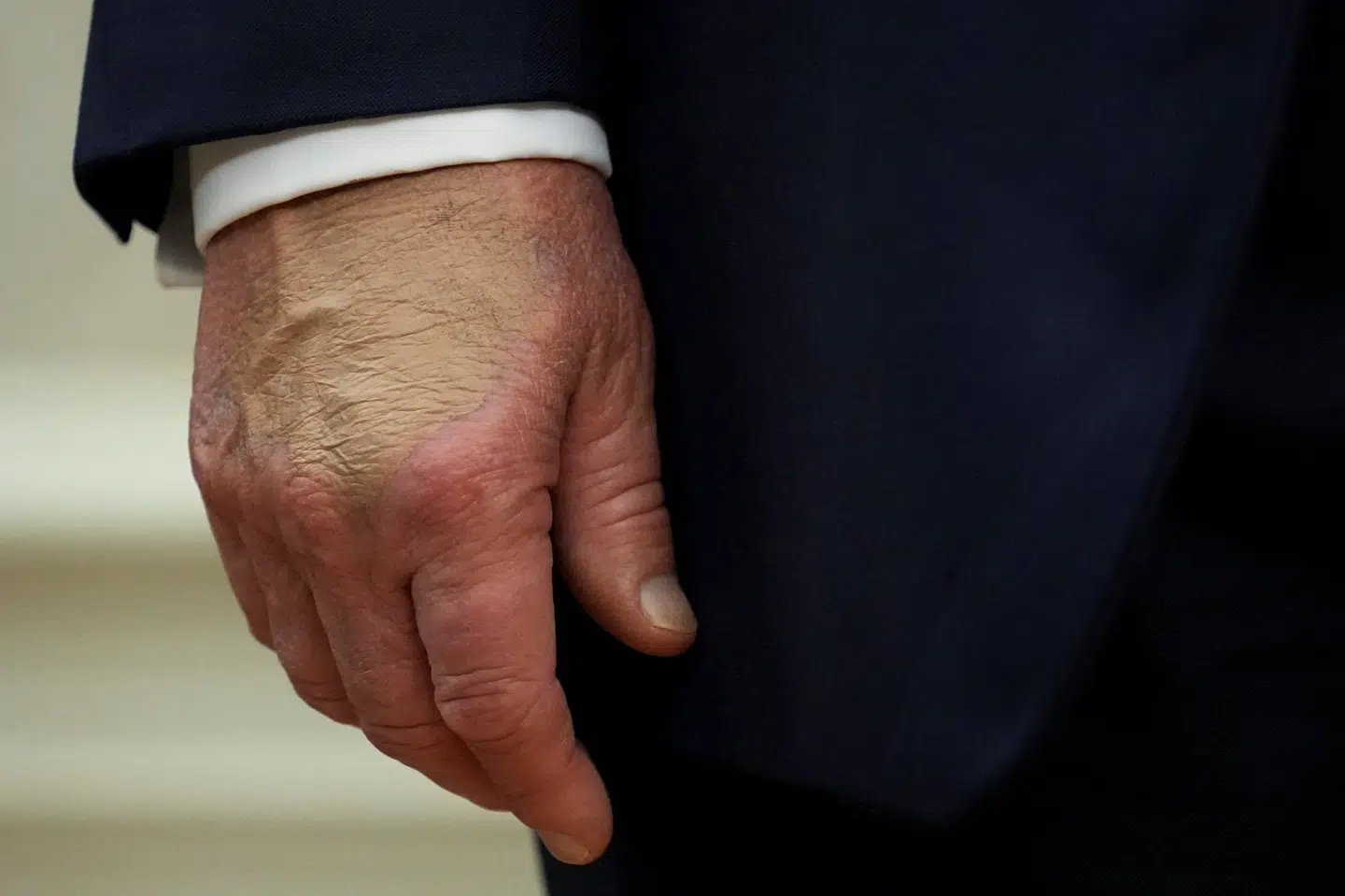 Donald Trumps højre hånd har ofte blå mærker, som er blevet tildækket. (Arkivfoto).