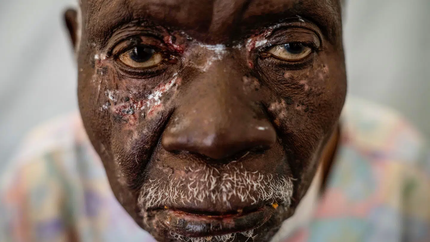 90-årige Christophe Chavilinga fik den frygtede sygdom, som også spreder sig i Europa.