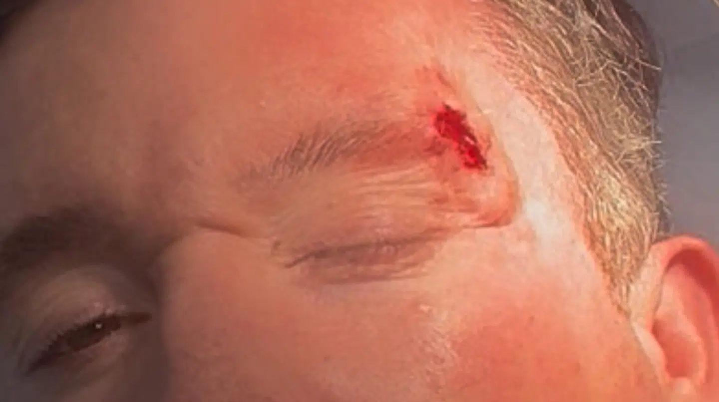 Robbie Fowler dokumenterer selv det indgreb, han har været igennem.