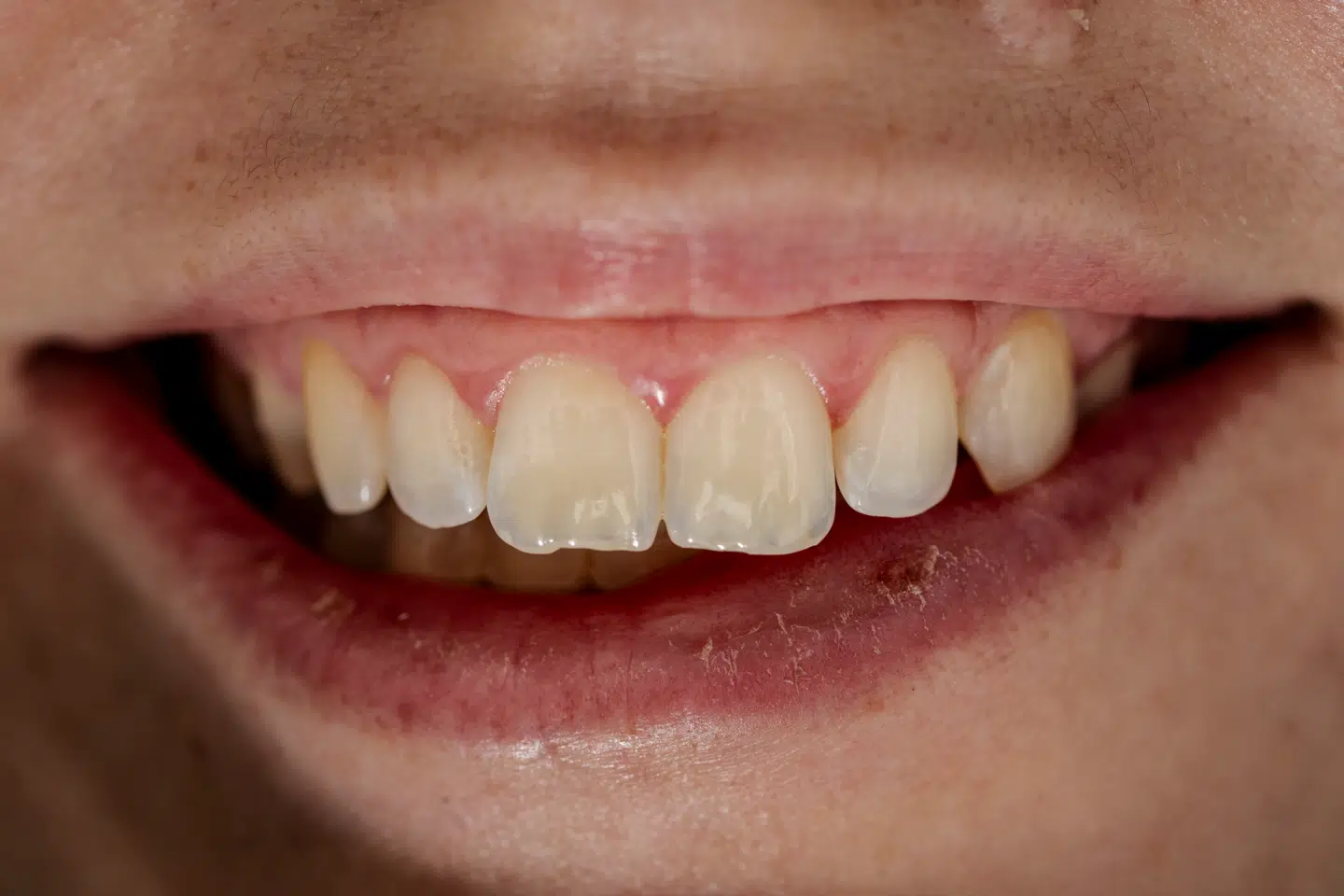 »Mit ønske er enkelt: at Danmark får et tandplejesystem, hvor almindelige mennesker kan få nødvendig behandling uden angst for store, uoverskuelige regninger,« lyder det fra tandlæge H.C. Wulff.