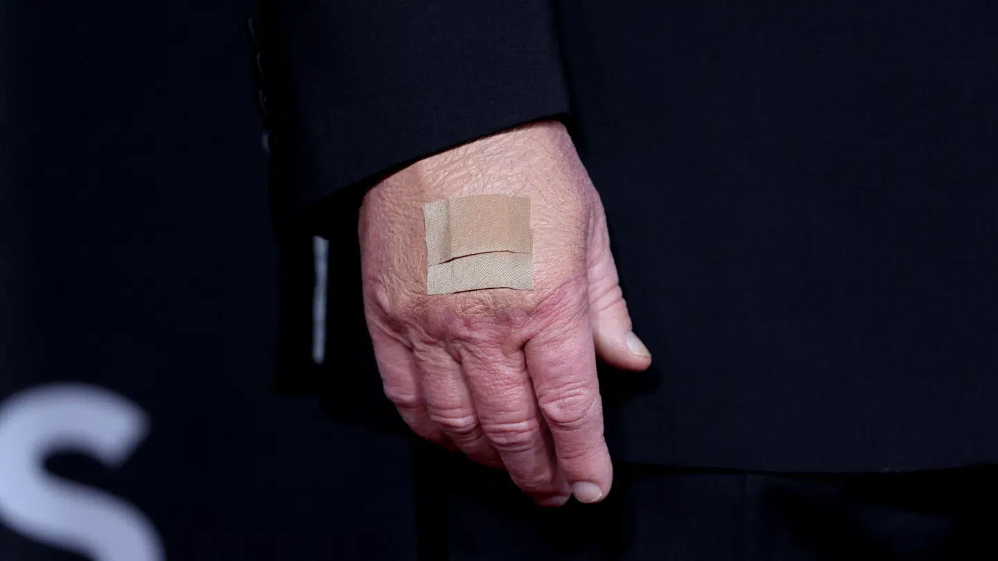 På billedet ses, hvordan et plaster dækker det område på Donald Trumps hånd, hvor det blå mærke plejer at være. Billedet er taget den 7. december 2025.
