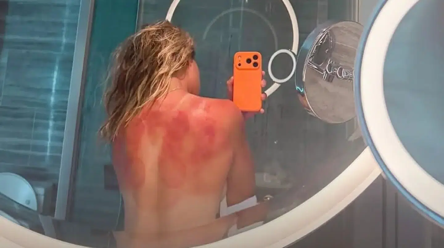 Solen har virkelig skoldet tennisspilleren.