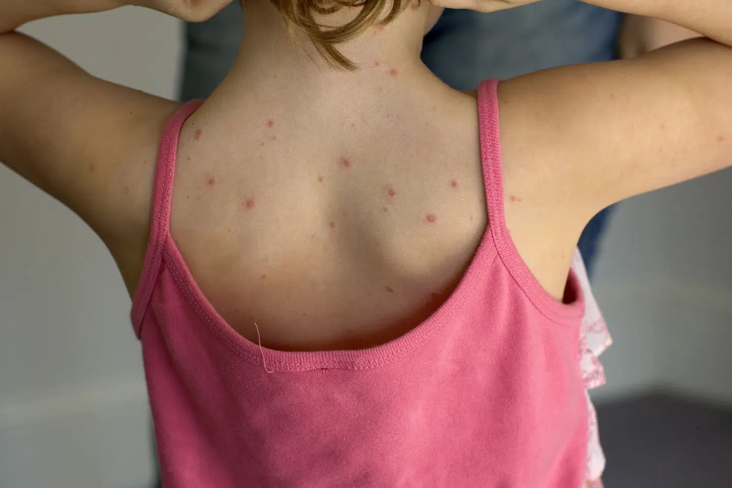 Det anslås, at over 90 procent af alle børn har været smittet med skoldkopper inden 10-års-alderen, og at 98 procent af alle voksne har haft sygdommen, som opstår ved infektion med Varicella-Zoster-virus. En del rammes så hårdt, at der nu tages skridt til at indføre en vaccine i børnevaccinationsprogrammet.