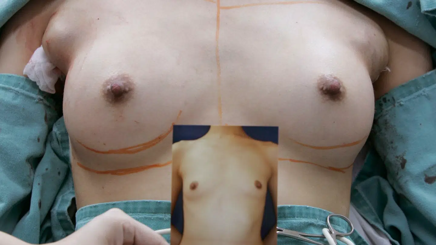 Tidligere har det krævet en operation og enten implantater eller eget fedt, at få forstørret sine bryster. I USA kan man nu lave indgrebet i lokalbedøvelse. Det kræver bare, at man kan leve med at det er fedt fra afdøde, der sprøjtes ind. Billedet er fra en brystoperation fra 2007.