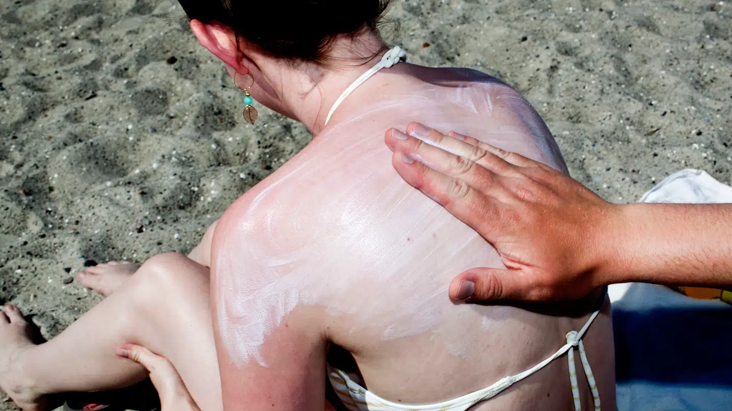 Hudkræft opstår blandt andet på grund af solskoldning.